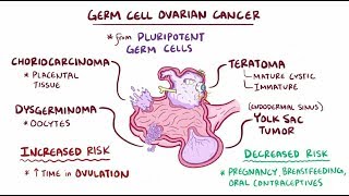 Germ cell ovarian tumors [upl. by Mahon]