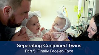 Separating Conjoined Twins Part 5 Finally FacetoFace [upl. by Cohlette]