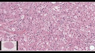 Granular cell tumor Breast  Histopathology [upl. by Alyce654]