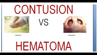 Surgery 011 Wound Contusion Hematoma Difference Vs Compare Between [upl. by Carrelli]