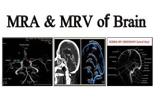 Cerebral Vascular Anatomy And Imaging [upl. by Troxell]