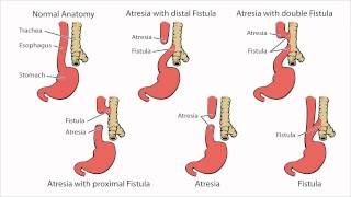 Tracheostomy  Respiratory phonatory and swallowing function  TRACS WA [upl. by Simmie]