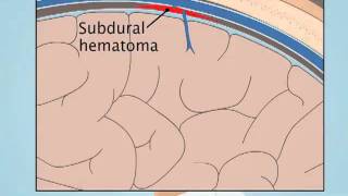 Understanding Subdural Hematoma [upl. by Nuli]