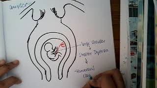 Macrosomia  obstetrics [upl. by Ahsyen]