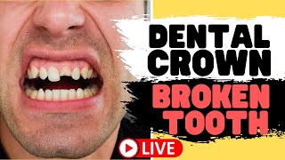 Tooth Crown Procedure  Front Tooth Crowns for Broken Teeth LIVE [upl. by Ahsitan]