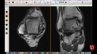 Calcaneofibular Ankle Ligament Stress Test Video Demonstration [upl. by Hendrix138]