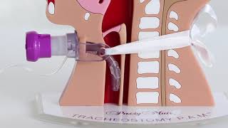 Laryngectomy  Leaking Voice Prosthesis  TRACS WA [upl. by Lakym681]