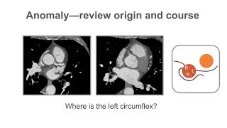 Tracheostomy PAM Valve Placement and Removal [upl. by Odlavu643]