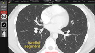 Lobar and Segmental Lung Anatomy on CT [upl. by Ajan]