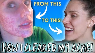 HOW I CLEARED MY ACNE  Chronic Cystic Digestive Hormonal [upl. by Adnilra991]