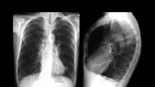 ENFISEMA PULMONAR [upl. by Eatnom]