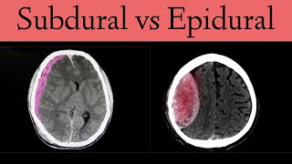 Subdural vs Epidural HematomaHemorrhage CT Scan Findings [upl. by Ettenal]