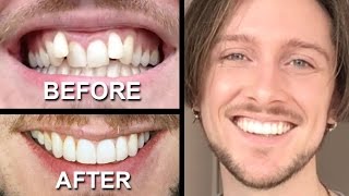 INVISALIGN REVIEW  everything you need to know [upl. by Anyaled]