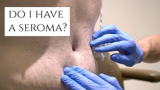 What is a Seroma  Fluid Build Up After Surgery  Symptoms and Treatment  Dr Daniel Barrett [upl. by Yenduhc540]