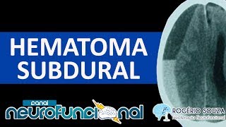 HEMATOMA SUBDURAL Vídeo Aula  TCE 3 [upl. by Dee Dee516]