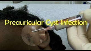 Preauricular Cyst Infection Management [upl. by Fiertz]