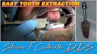 Easy Tooth Extraction  Dental Minute with Steven T Cutbirth DDS [upl. by Roselyn]