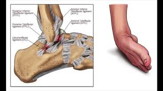 InternalBrace™ ATFL Talus to Fibula Ligament Augmentation [upl. by Nosduj]