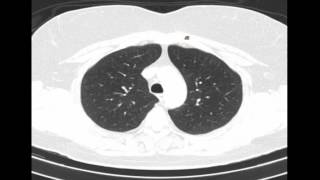 Radiologia para Estudiantes TC PULMON Y TRAQUEA [upl. by Slocum]