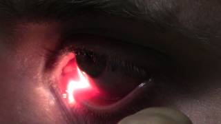 Ophthalmic Skills Video  Basics in Slit Lamp Examination [upl. by Haiacim]