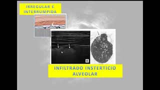 CURSO BASICO DE ECOGRAFIA PULMONAR 5 Signos ecograficos II [upl. by Araj]