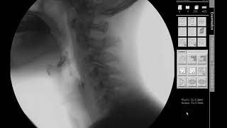 Tracheo Oesophageal Fistula Types Made Easy TOF Mnemonics USMLE [upl. by Alfy]