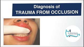 Diagnosis of TRAUMA FROM OCCLUSION TFOCLINICALRADIOGRAPHICFREMITUS TESTDR ANKITA KOTECHA [upl. by Manda721]