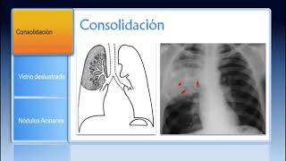 Patrones Pulmonares en Radiología y TC [upl. by Marcus]