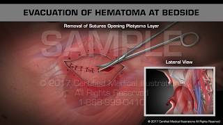 Evacuation of Hematoma at Bedside [upl. by Margarette]