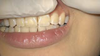 Periodontal Examination Series 8 Fremitus Test [upl. by Tilford86]