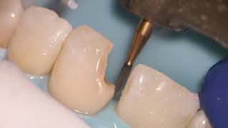 Teeth Bonding  Front tooth filling EXPLAINED [upl. by Kletter530]