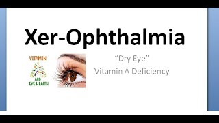 Ophthalmology 475 Xerophthalmia Vitamin A deficiency Eye Night blindness Ocular Classify Pediatrics [upl. by Noguchi]