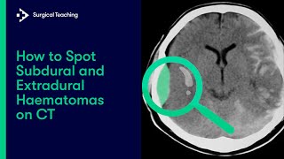 Extradural vs Subdural Haematomas  How do we Diagnose them on CT [upl. by Nazar746]