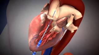 SAPIEN TAVR Deployment Using Transapical Approach [upl. by Niobe]