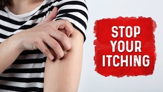 What Causes Hives and Itchiness  Urticaria Hives Treatment  Dr Berg [upl. by Jerad]