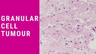 Granular Cell Tumour  Pathology mini tutorial [upl. by Aires]