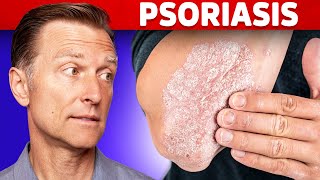 Psoriasis Treatment – The Best 3 Remedies for Psoriasis – DrBerg [upl. by Concepcion371]