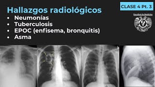 043  Neumonía TB EPOC Enfisema Bronquitis Bronquiectasias Asma [upl. by Murphy84]