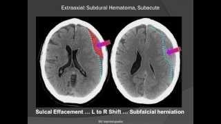 Subdural Hematoma SDH [upl. by Hynda28]