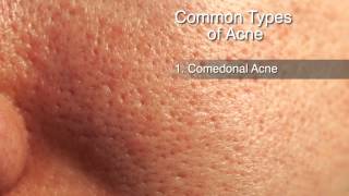 How to Treat Different Types of Acne [upl. by Davies]