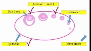 12DaysinMarch Ovarian Tumors for USMLE Step One [upl. by Janeta]