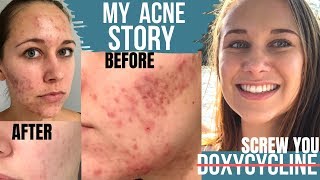 Acne Antibiotics DOXYCYCLINE MAKES ACNE WORSE  My Acne Story BEFORE amp AFTER with PICTURE TIMELINE [upl. by Airrotal]