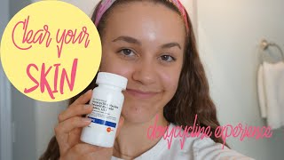 How To Get Rid of Acne  My Doxycycline Experience [upl. by Notyal]