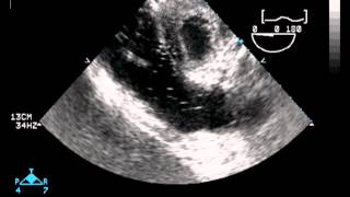 Transesophageal Echocardiography [upl. by Arres]