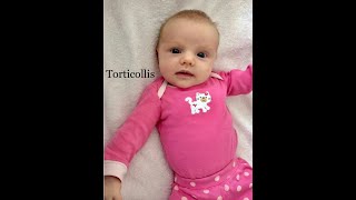 Infant Phys Therapy  Torticollis exercisesPart6 [upl. by Aara]