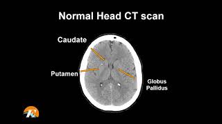 Normal Head CT Scan Anatomy Made Simple Neuroradiology [upl. by Akiraa]