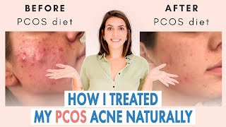 How I Healed My Cystic Acne NATURALLY PCOS amp Hormonal Acne [upl. by Kernan]