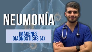 NEUMONÍA  Imágenes diagnósticas Parte 4 [upl. by Anrak680]