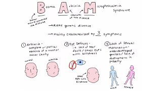 Bosma arhinia microphthalmia syndrome BAM syndrome [upl. by Brentt]