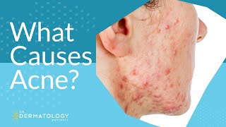 What Causes Acne  Explained by Dermatologist [upl. by Boru]